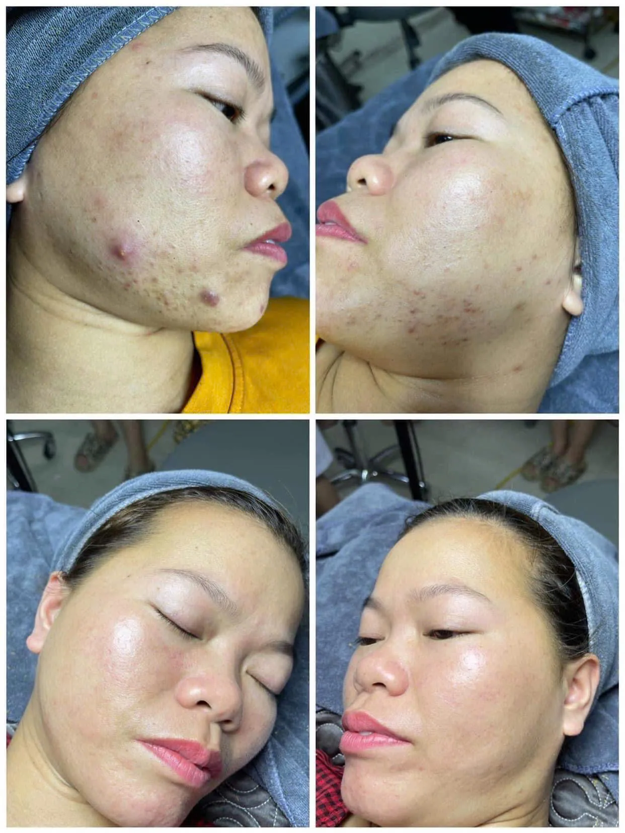 Acne Treatment result at DIVA Skin Clinic Poipet