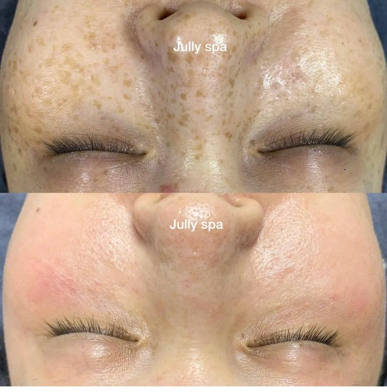 Dark Spots on Legs at DIVA Skin Clinic Poipet