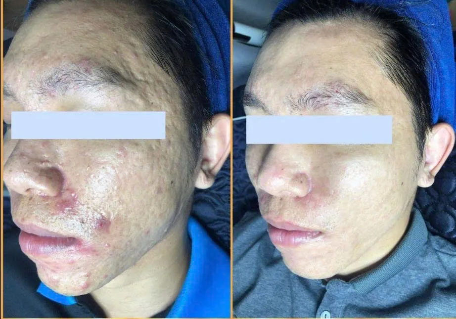 CO2 laser scar treatment results