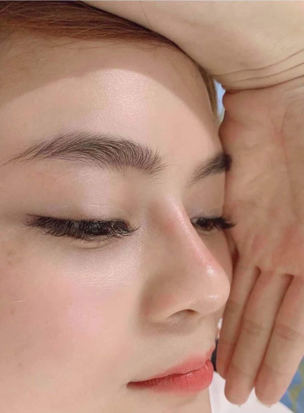 Botox and Filler in Poipet results