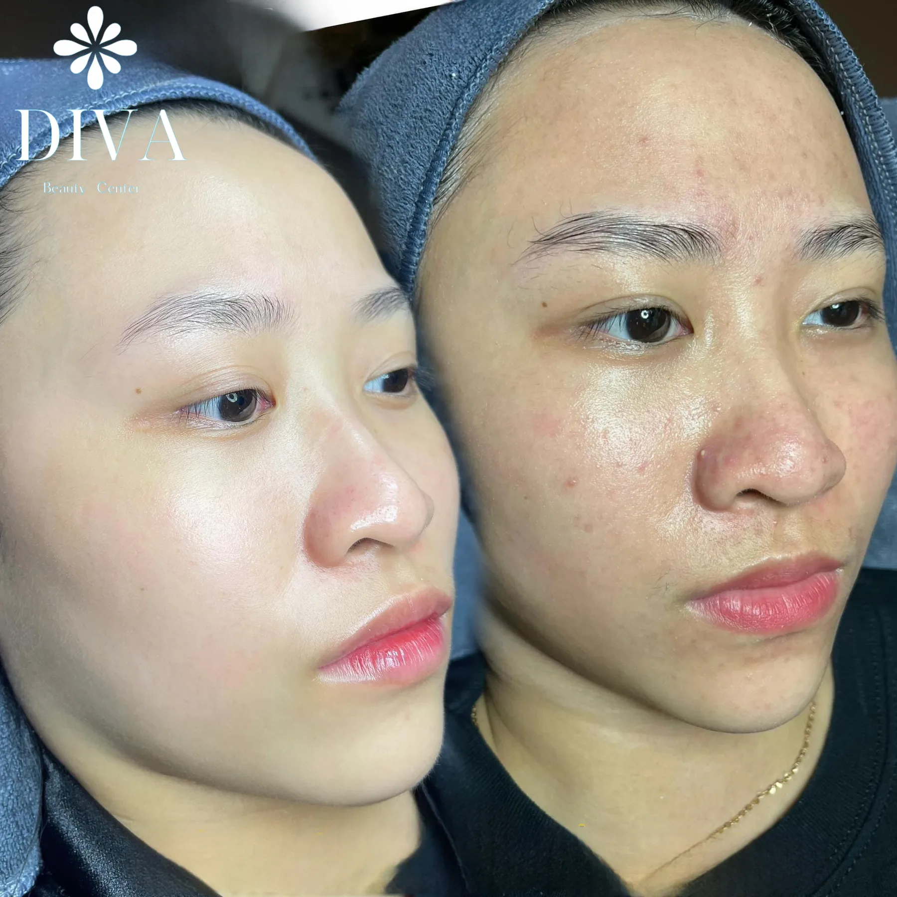Back Acne Treatment at DIVA Skin Clinic Poipet